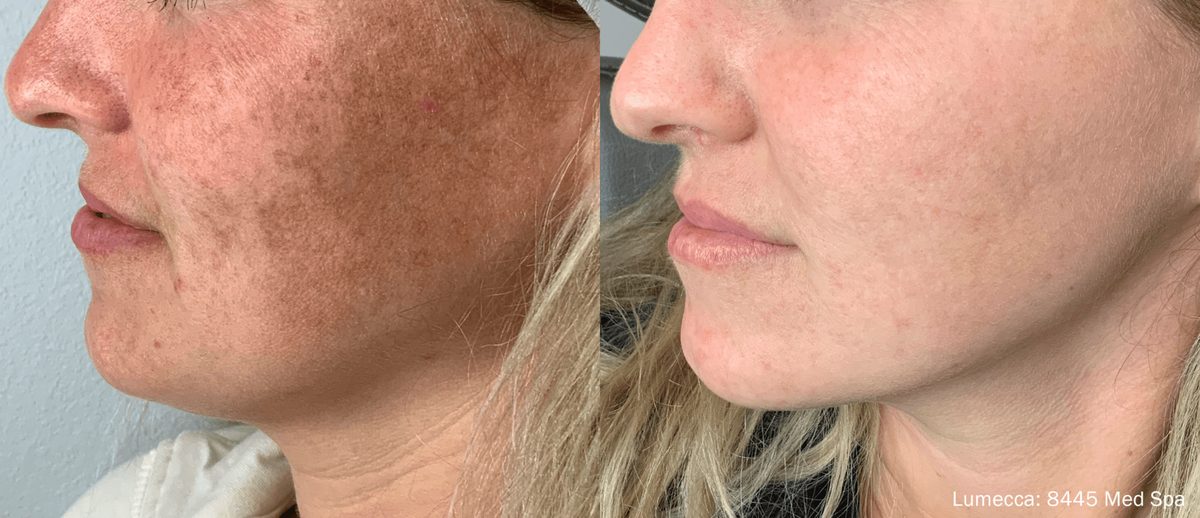 Lumecca IPL before and after result