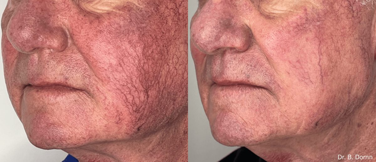 Lumecca IPL before and after result