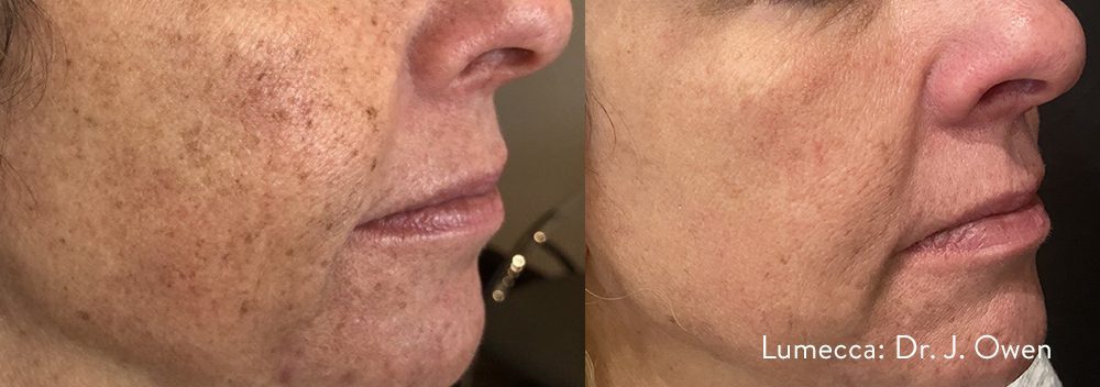 Lumecca IPL before and after result