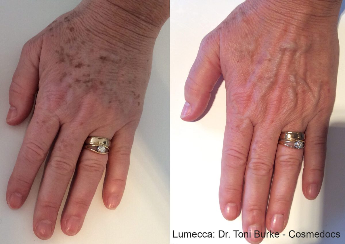 Lumecca IPL before and after result