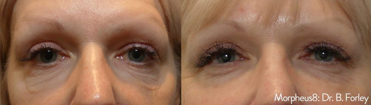 Morpheus8 before and after result